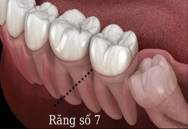 nhổ răng số 7 có bị hóp má không