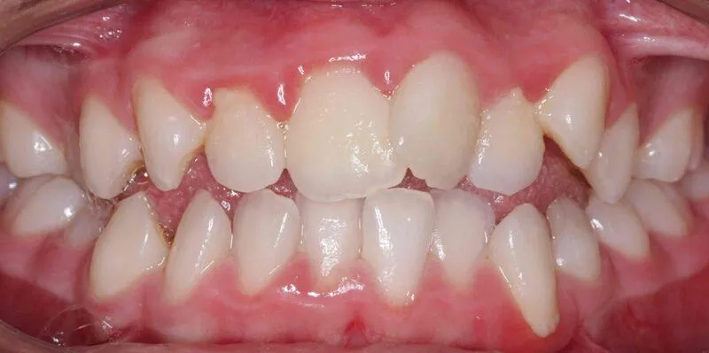 răng mọc lộn xộn
