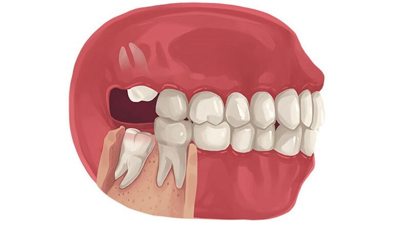 nhổ răng hàm có ảnh hưởng đến thần kinh không