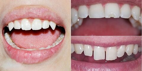 mài răng bọc sứ có đau không