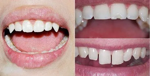 mài răng bọc sứ có đau không