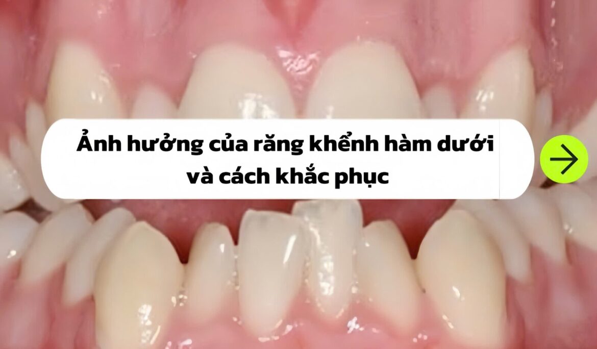 răng khểnh hàm dưới