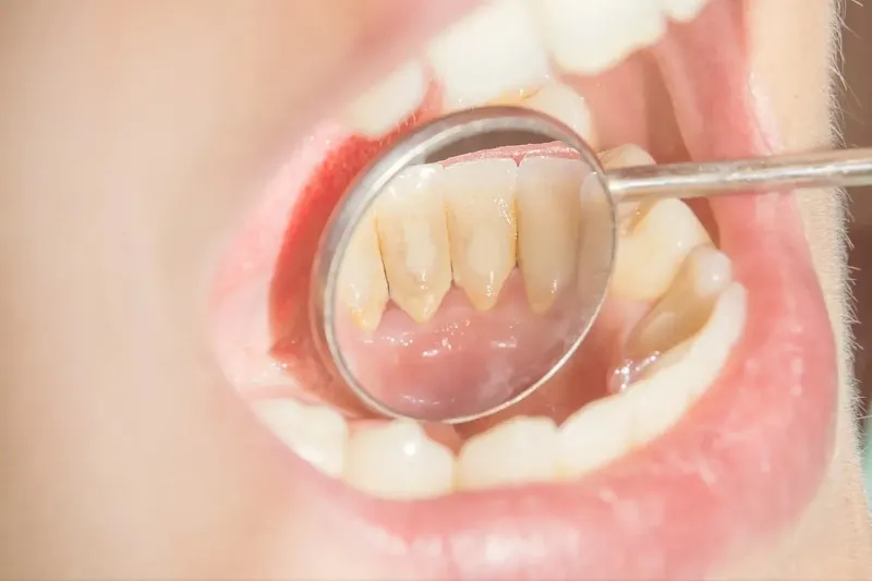Có nên lấy cao răng thường xuyên không
