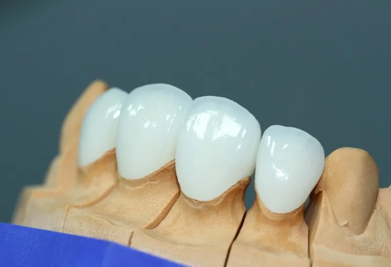 Bọc răng sứ 4 răng cửa bằng răng sứ toàn sứ