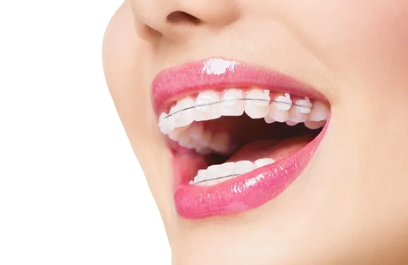 Niềng răng có được vĩnh viễn không
