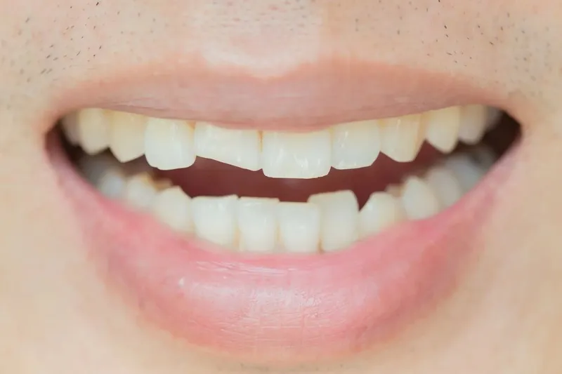 Các nguyên nhân dẫn đến răng bị mẻ