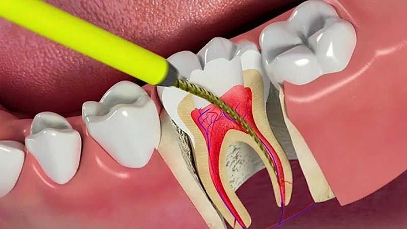 Chữa tủy răng mất bao lâu