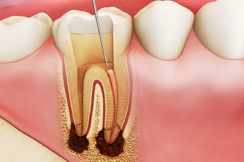 Khi nào phải lấy tủy răng sữa