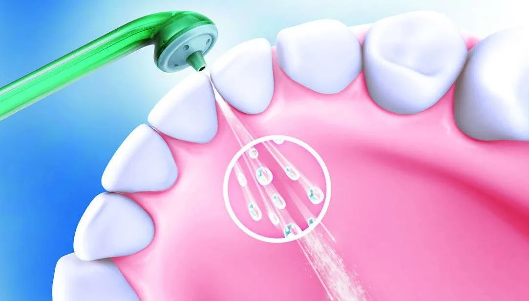 Tầm quan trọng của việc làm sạch kẽ răng