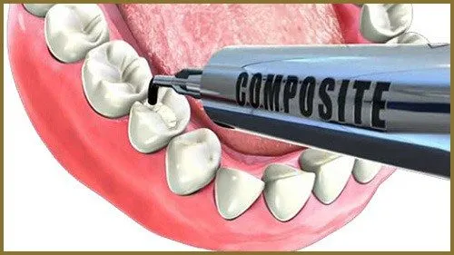 phuong-phap-dan-rang-composite-2