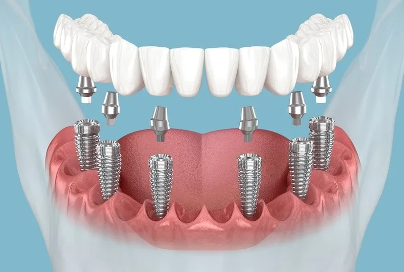 ky-thuat-cay-ghep-implant-phuc-tap-4