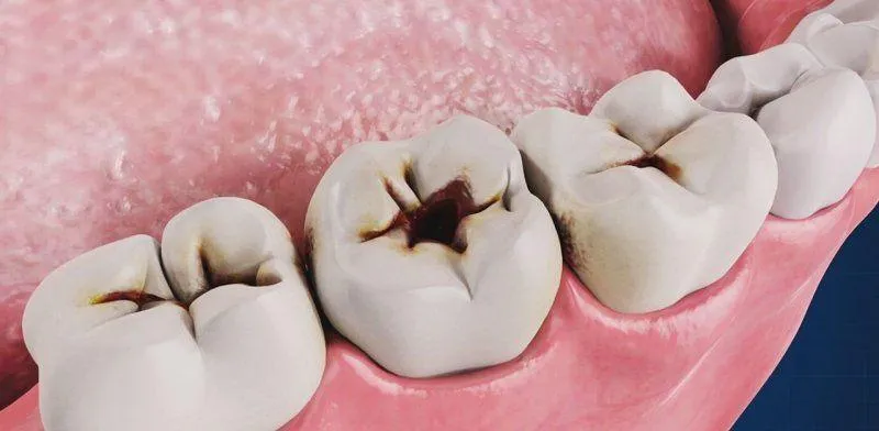 Cách phòng ngừa răng sâu sau điều trị