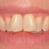 Răng cánh bướ là một khuyết điểm về hình dáng răng