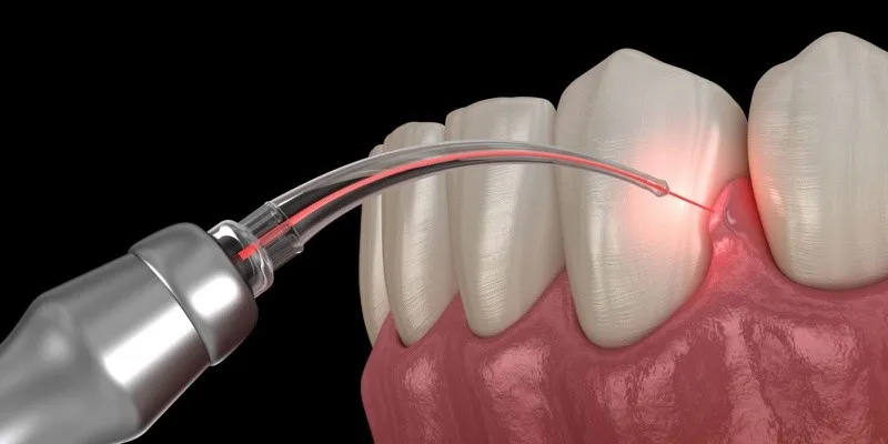 Các Yếu Tố Ảnh Hưởng Đến Cảm Giác Đau Sau Cắt Lợi Laser