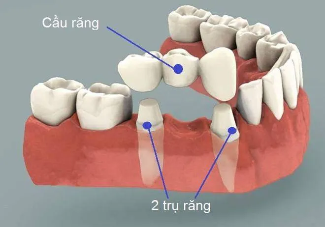 mầm răng vĩnh viễn