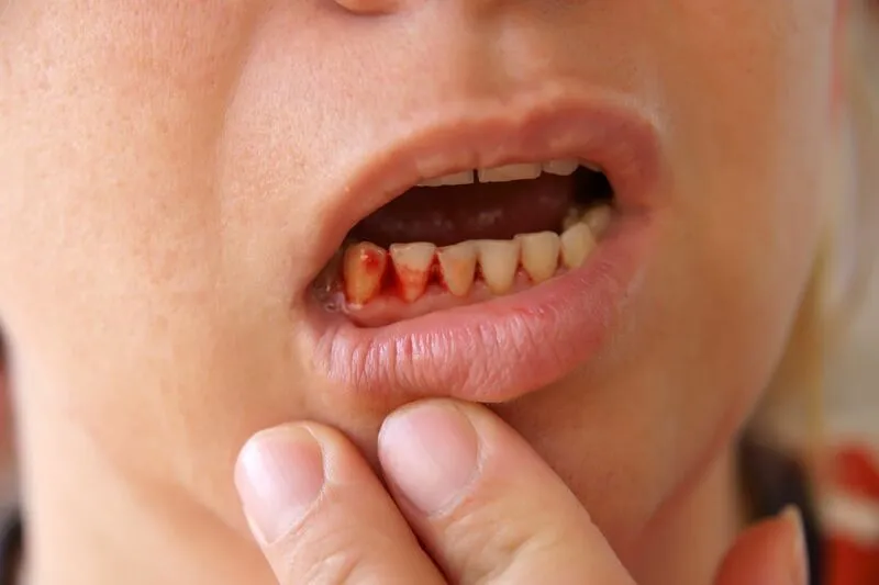 nú răng bị chảy máu