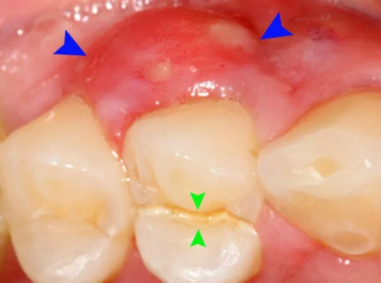 hình ảnh viêm nướu răng ở trẻ