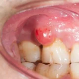 áp xe nướu răng có tự khỏi không