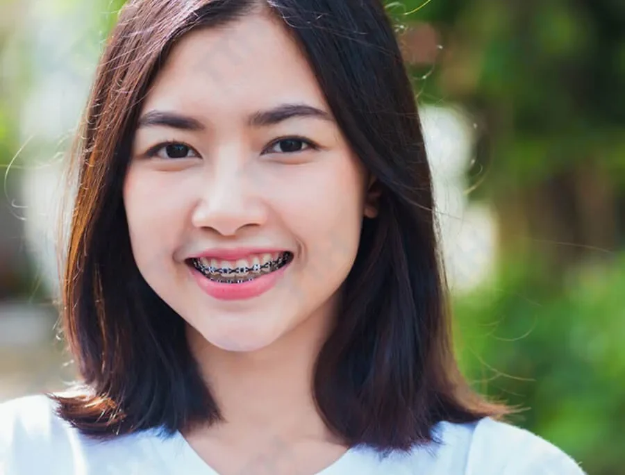 niềng răng có được dùng bảo hiểm y tế