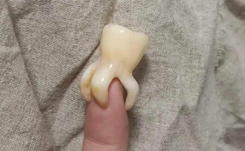 Răng khôn có mấy chân