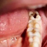 có nên trồng răng số 8